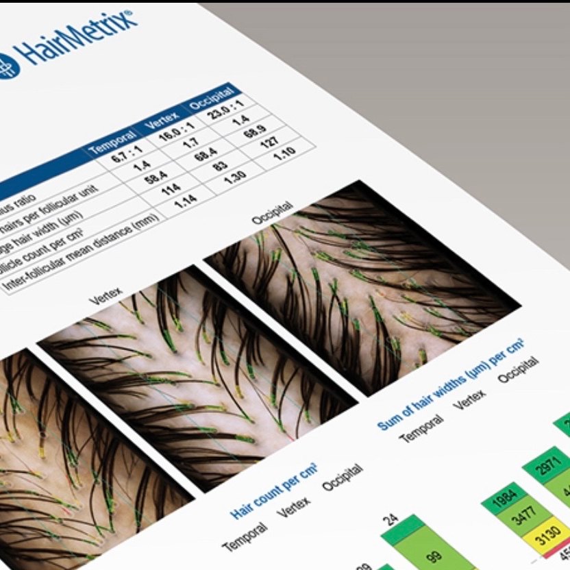 Printed scalp analysis report