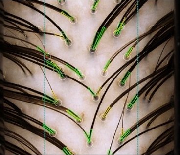Occipital zone scalp capture