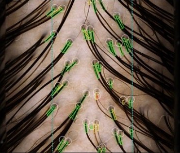 Temporal zone scalp capture